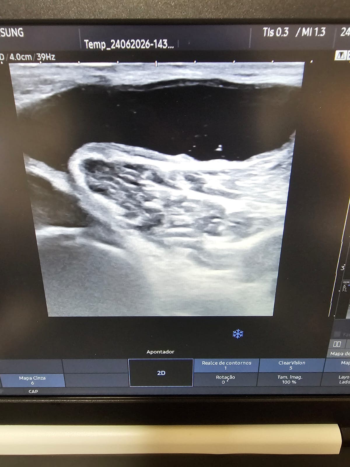 Ultrassom mostrando cisto de Baker atrás do joelho — avaliação com Dr. Leonardo Wustro, ortopedista em Curitiba